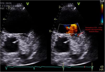 Case Report: Multimodality evaluation and clinical management of a single coronary artery